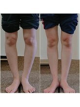 クシロ鍼灸整骨院/【O脚矯正】施術例