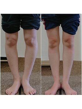 クシロ鍼灸整骨院/【O脚矯正】施術例