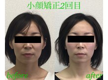 オズ六本木/小顔矯正施術2回目＠オズ六本木