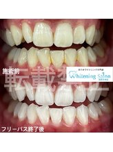 ホワイトニングサロン 福岡天神店/ホワイトニング