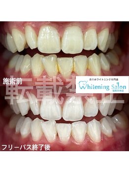 ホワイトニングサロン 福岡天神店/ホワイトニング
