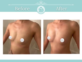 美人バスト 柏店/バストアップ症例(谷間出現)