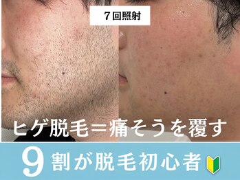 アロマ(AROMA)の写真/《青ヒゲ・肌荒れが気になる方へ》ヒゲを減らしながら肌まできれいに!初めてのヒゲ脱毛に◎