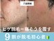アロマ(AROMA)の写真/《青ヒゲ・肌荒れが気になる方へ》ヒゲを減らしながら肌まできれいに!初めてのヒゲ脱毛に◎