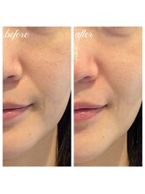 シーズボーテ(C's Beaute)/毛穴たるみ改善でツヤ・ハリUP♪