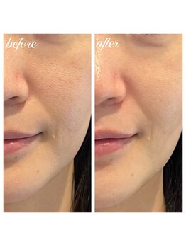 シーズボーテ(C's Beaute)/毛穴たるみ改善でツヤ・ハリUP♪