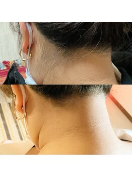 プチサロン ラナ(LANA)/うなじWAX脱毛