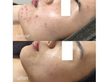 スピカ(Spica)/spicaのニキビケア