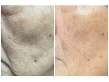 クリスタルボウ(Crystal BEAU)/シミしわたるみハリツヤ改善2回