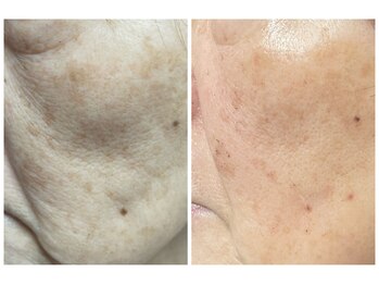 クリスタルボウ(Crystal BEAU)/シミしわたるみハリツヤ改善2回