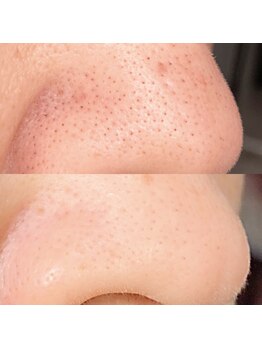 プライベートサロン結の写真/毛穴の黒ずみ・汚れが気になる…素肌力をUPしたい方は当店の【ハイドロフェイシャル】がおすすめ☆