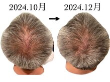 フェイススタンド 芦屋(FACE STAND)の雰囲気（頭蓋骨調整2回目頭皮の変化/髪の毛の密集率が上がりボリュームUP）