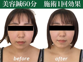もみの木鍼灸整骨院 恵比寿/理想の輪郭を導く美容鍼