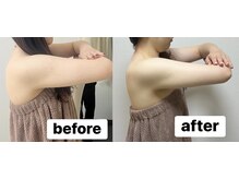 アテ 国分寺店(Ate)/激痩せ打たない脂肪分解？！