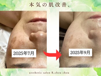 アール シュシュ(R.chouchou)/本気の肌改善ガリレオピーリング