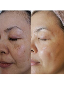 トラット エステアンドアイズ(tratto)/40代　お客様症例写真