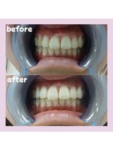 パレ 大阪十三店(Palet)/２回照射後のbefore/after