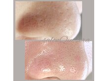 毛穴洗浄ケア：毛穴詰まり・黒ずみ・ざらつき・開き