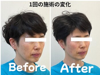 ゆず鍼灸整骨院/当院人気NO1！美容鍼モニター様