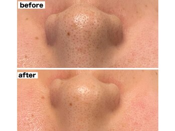 リリーココ(Lily Coco)/毛穴