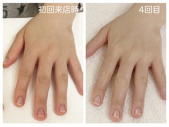 キレイテ 福岡天神店/乾燥と手荒れ