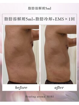 リリ(RIRI)の写真/【脂肪コントロール導入店♪】サイズダウン/ハミ肉/老廃物を流すなどあなたの気になる箇所を短期集中ケア♪