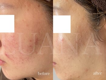 ルアナ(LUANA)/VOSサロンケア（ニキビケア）