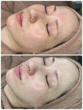 ララ(LALA)/姪浜ララピール/韓国最新肌管理