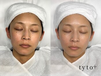 タイトプラス(tyto+)/プラチナプラピール