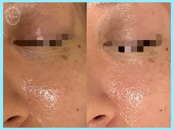 ハーブピーリング 名古屋/キメが整い艶やかなお肌に