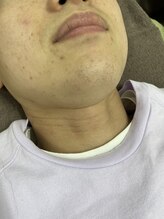 ナノハナ/鹿沼市の全身脱毛のナノハナ