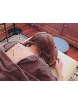 鍼灸施術を受けたい