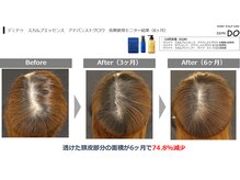 ユトレ(yutre)/頭皮や細毛にお悩みの方必見！