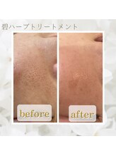 プライベートサロン ヴィヴィアン(Vivian)/肌のお悩みに★ハーブピーリング