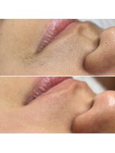 プライベートエステティックサロン クール(Coeur)/【たまご肌シルキー脱毛コース】