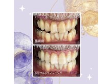 ホワイトニングプラス(Whitening+)/気になっていた黄ばみを除去