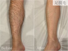 ケリーズ(KELLY `S)/足脱毛/熊本