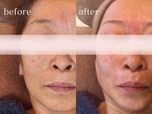 ハダケア(HADA CARE)/フェイスワックス