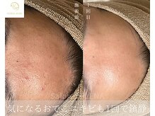 サロンドレナ 名駅店/ハーブピーリング サロンドレナ