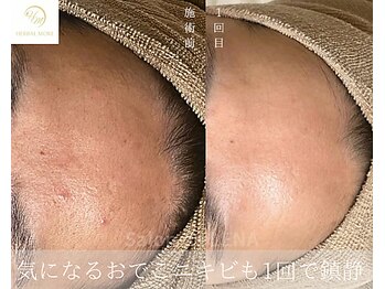 サロンドレナ 名駅店/ハーブピーリング サロンドレナ