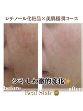 レアルステイト 御経塚店/しみ/しわ/たるみ/美白