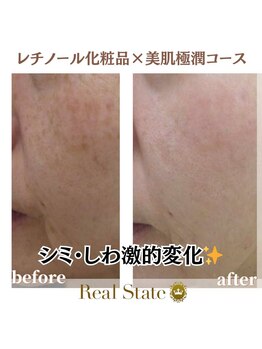 レアルステイト 御経塚店/しみ/しわ/たるみ/美白