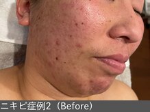 オアシスラグーン(OASIS LAGOON)/ニキビ改善（症例2 before）