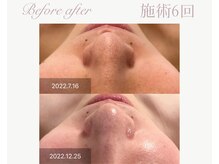 パルタージュ(Partage)/毛穴の黒ずみ/開き改善