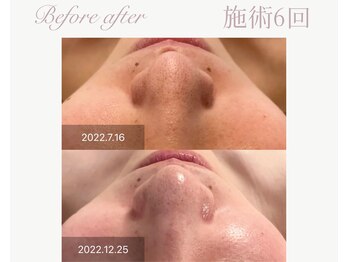 パルタージュ(Partage)/毛穴の黒ずみ/開き改善