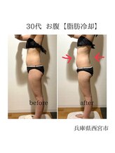 ルーチェエムベルシック(Luce.MBelChic)/お腹の脂肪冷却