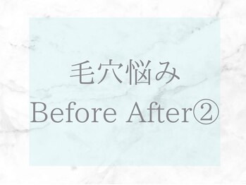 ネオファースト(NeoFirst)/毛穴のビフォーアフターをご紹介