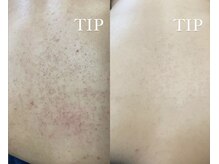 ダリア(Dahlia)/背中ハーブピーリング