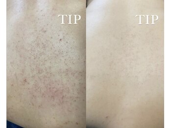 ダリア(Dahlia)/背中ハーブピーリング