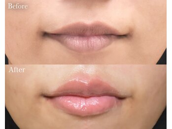 ライム 中野(LIME)/ローマピンク｜黒ずみケア